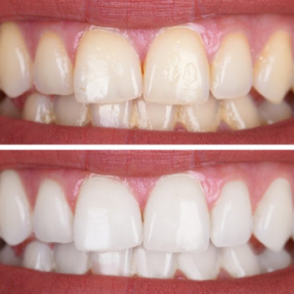 Close-up,Of,A,Smiling,Woman's,Teeth,Before,And,After,Whitening