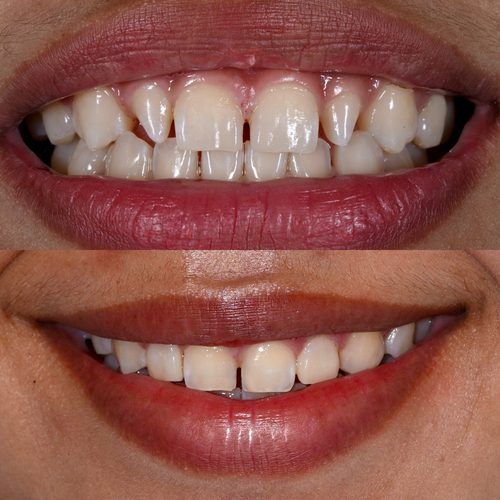 Before,And,After,Reshape,Peg-shaped,Tooth,With,Composite,Veneer