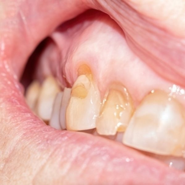 Close-up,Of,A,Worn,And,Fractured,Dentition,Of,An,Elderly