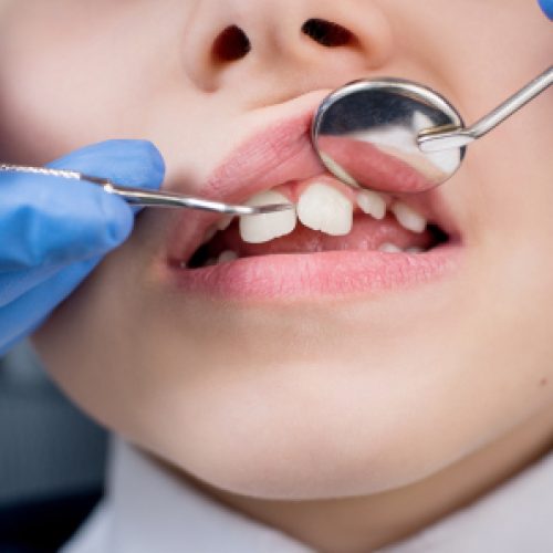 Close-up,Of,Dentist's,Hand,Examining,Teeth,Of,Boy,Patient,In